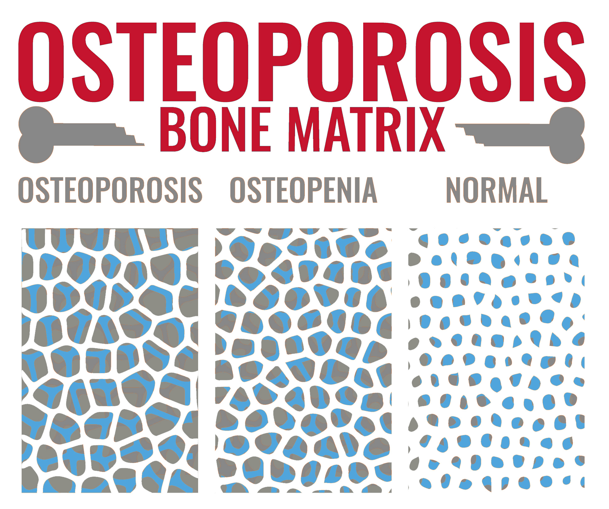 ossa osteopor